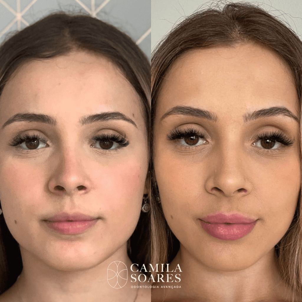 Harmonização Facial - Dra. Camila Calazans