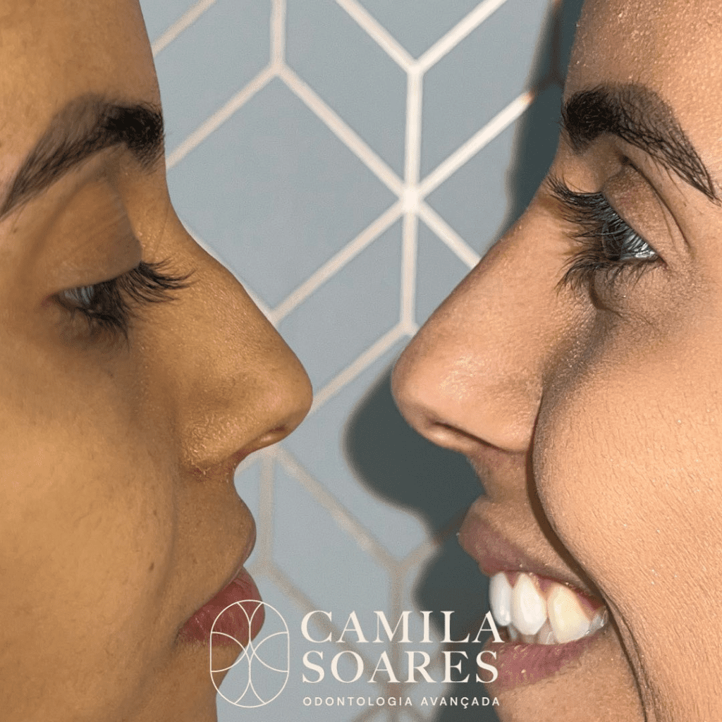 Harmonização Facial - Dra. Camila Calazans